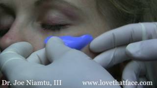 Choosing the Right Cheek Implant for your Face [upl. by Nepets]