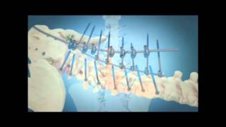 Scoliosis Surgical Correction with Instrumentation [upl. by Sesylu160]