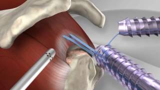 Knotless Rotator Cuff Repair with Arthrex® SpeedFix™ [upl. by Lauder]