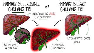 Primary Sclerosing Cholangitis v Primary Biliary Cholangitis Primary Biliary Cirrhosis [upl. by Taka716]