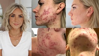 How I Cured My Adult Hormonal Cystic Acne Naturally no accutane [upl. by Doak669]