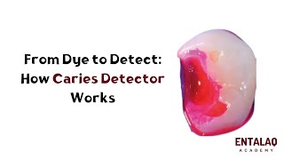 From Dye to Detect How Caries Detector Works [upl. by Ycnaf844]