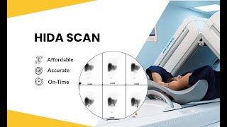 Bile Scintigraphy  Hepatobiliary Iminodiacetic acid Scan HIDA SCAN [upl. by Iredale]