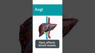 What are the Types of Liver Cancer यकृत कैंसर के प्रकार क्या हैं shorts [upl. by Harad632]