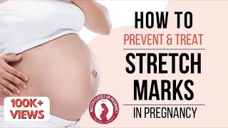 How to prevent and treat Stretch Marks in pregnancy Dr Anjali Kumar  Maitri [upl. by Inail823]