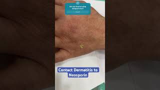 Neosporin Allergy Expert dermatologist reveals the Truth drashimagoel dermatologistinpunjab [upl. by Bethezel921]