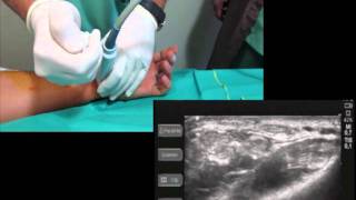 UltrasoundGuided Wrist block [upl. by Alek]